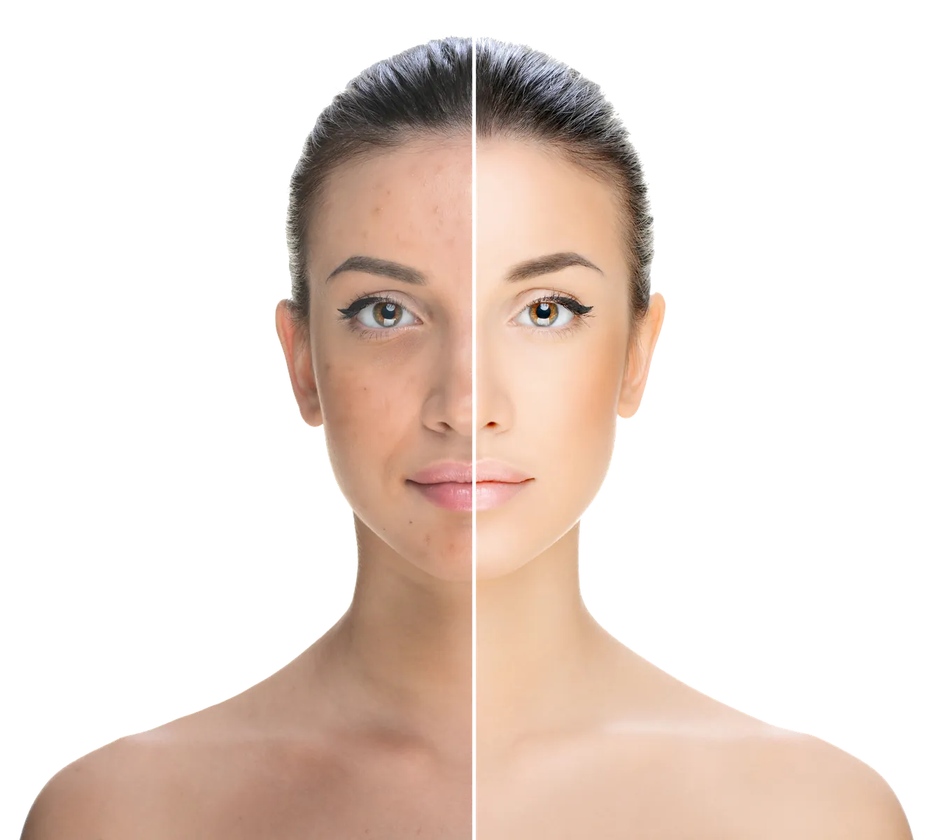 The half left side of a woman has pigment on her skin, while, the other half right side of a woman has a clear skin.