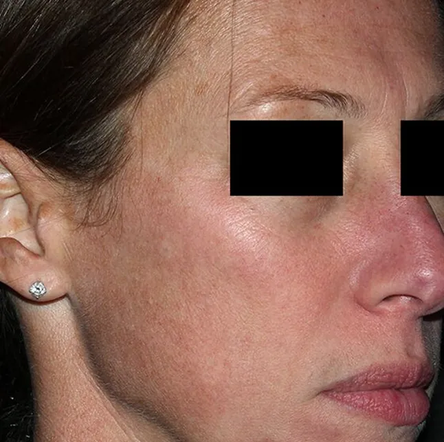 melasma-aft