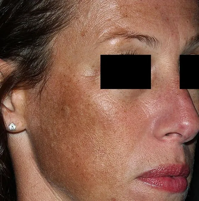 melasma-bf