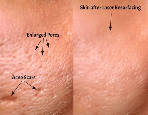 Skin Resurfacing