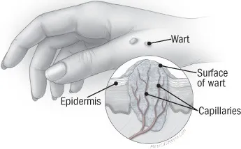 Wart anatomy