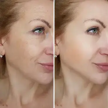 All You Need to Know about Laser Skin Resurfacing