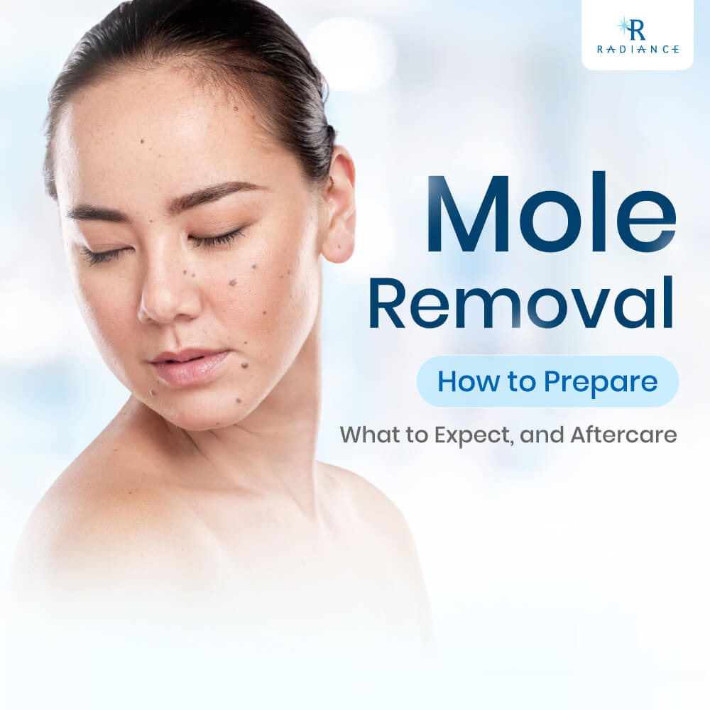 moles removal