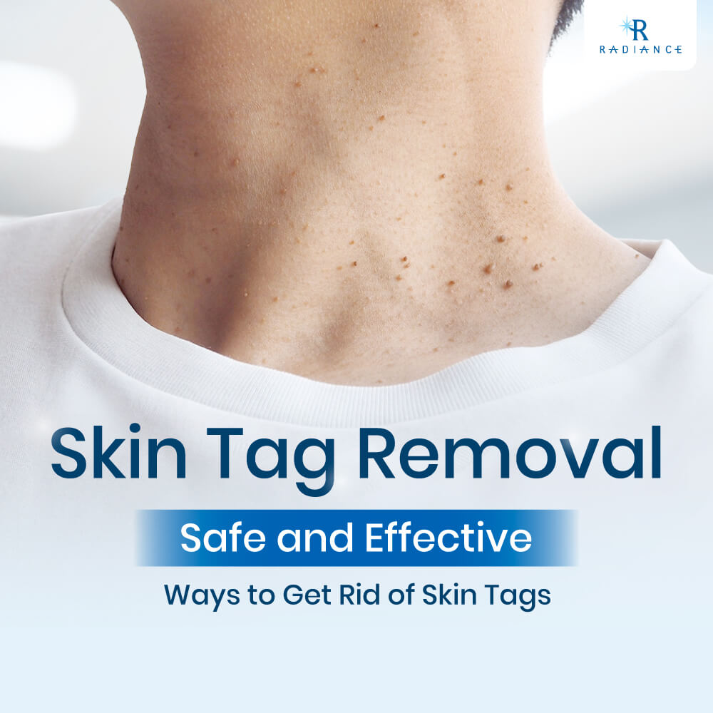 Skin tag removal