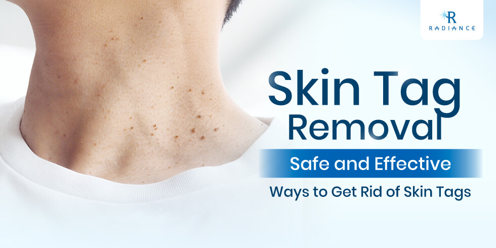 Skin Tag Removal: Safe and Effective Ways to get rid of them
