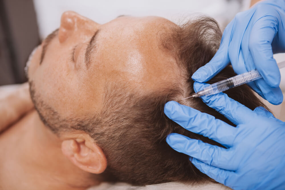 An injection of PRP directly to the scalp