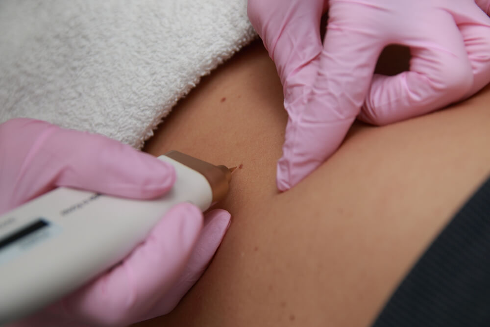 A woman’s patient under a skin tag removal process
