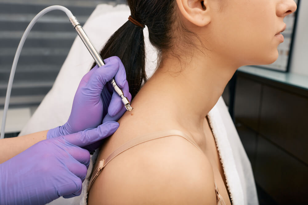 A woman’s patient under a mole removal process