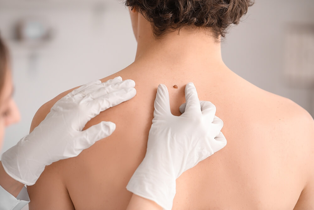 Physician diagnosing abnormal moles
