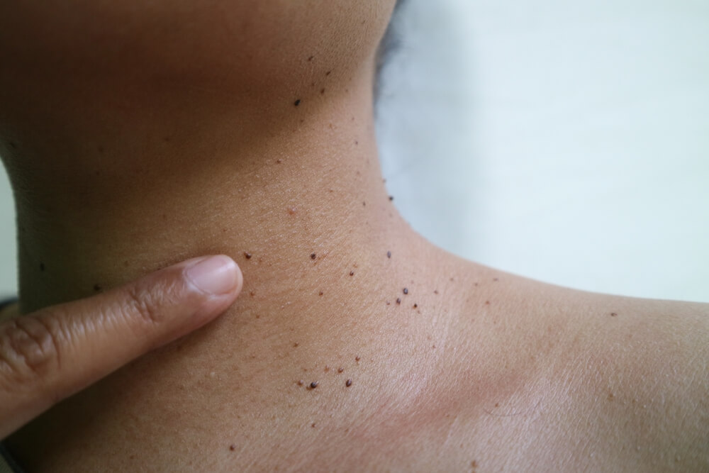 Close-up photo of multiple skin tags
