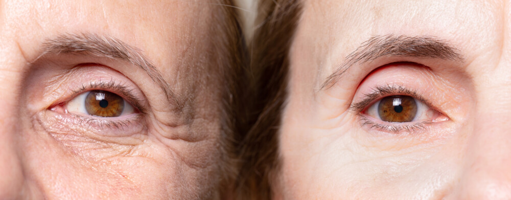 Signs of aging in the eye area