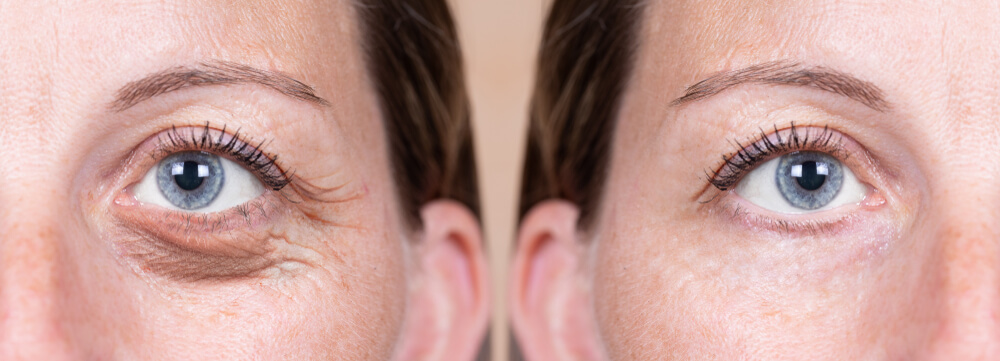Post-operation visible improvement of the eyelid